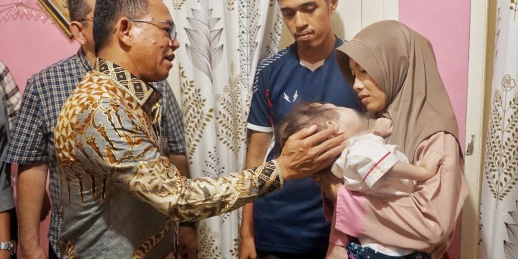 Mikhayla, Balita Yang Berjuang Melawan Kanker Mata, Mendapat Perhatian Khusus Dari Wakil Wali Kota Medan